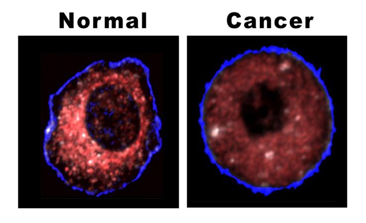 Figure 1: Mitochondrial Distribution in Normal vs. Cancerous Cell.