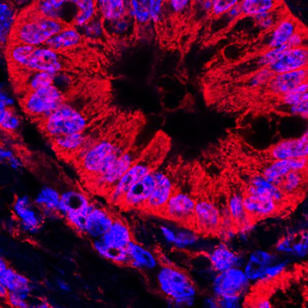Figure 2: Mitochondrial Dynamics in Cancerous Cell. The cristae of the mitochondrion are damaged.