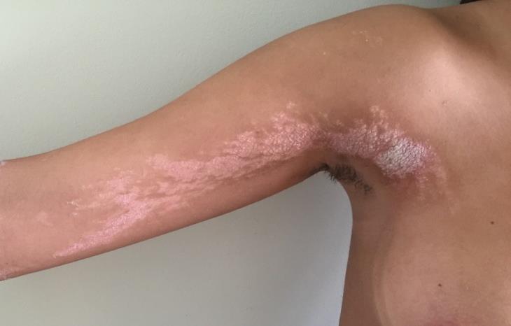 Figure 1: Erythematous-squamous plaques following the lines of Blashkow.