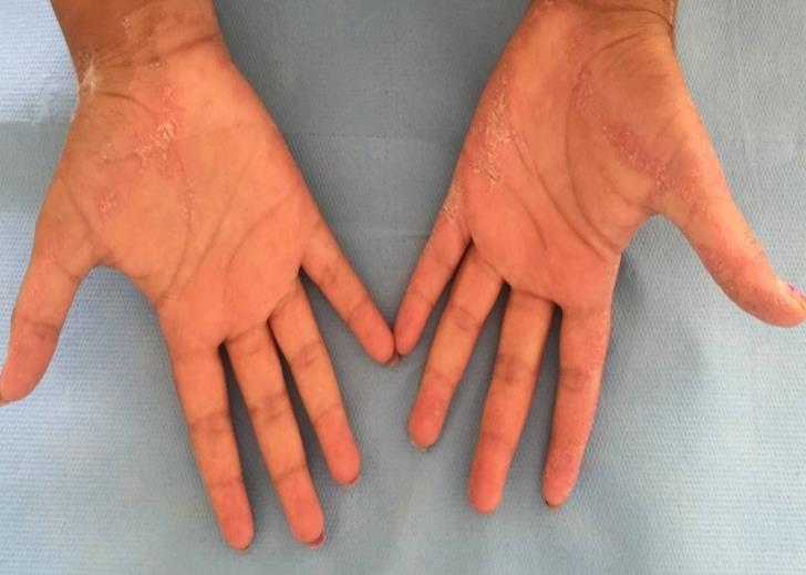 Figure 2: The palmar localisation.