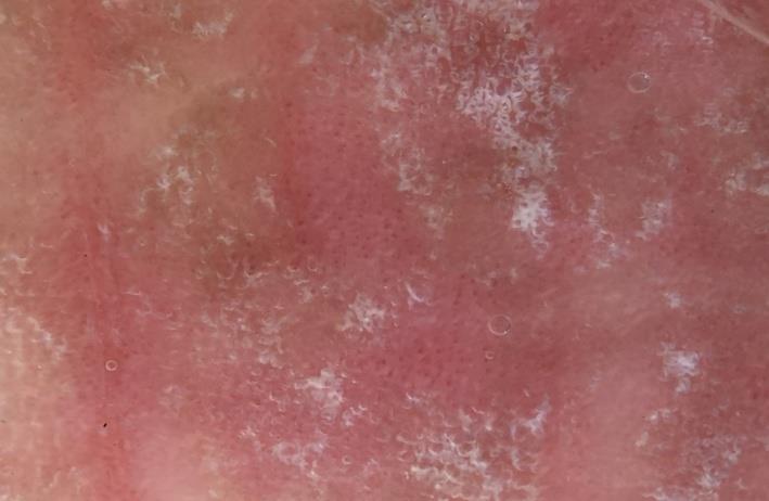 Figure 4: Dermoscopic image showed a homogeneous and regular dotted vascularization.