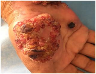 Figure 1: Ulcerous-budding tumor of 6cm, nippleted, surmounted by hemorrhagic crusts, taking the thear lodge of the right hand with satellite lesions.