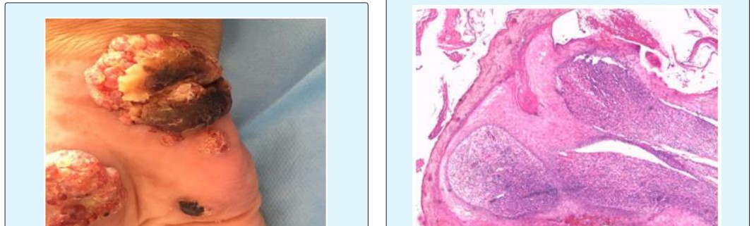 Figure 3: Dermoscopic image: Papillomatous aspect with haemorrhagic and mellicheric crusts.