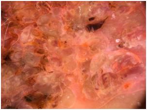 Figure 4: Dermoscopic image after immersion: aspect in rainbow, polymorphic vascularization within the papillae.