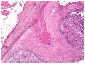 Figure 5: Histological image: Coloration HES G x 50: Hyperacanthosis, papillomatosis, hyperkeratosis and dermal inflammatory infiltrate.