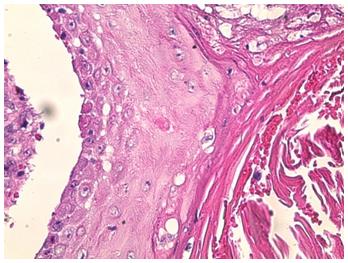 Figure 6: Histological image: Coloration HES G x 100: Vacuolated keratinocytes in surface, sometimes binucleated.