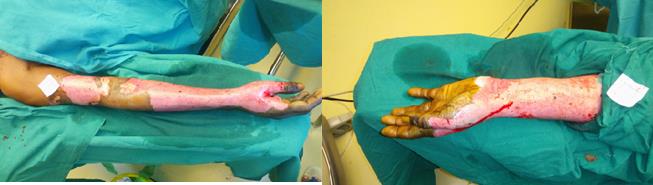 Figure 2: Burn wounds on both upper limbs.