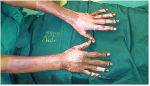 Figure 3: After LLLT 2nd session.