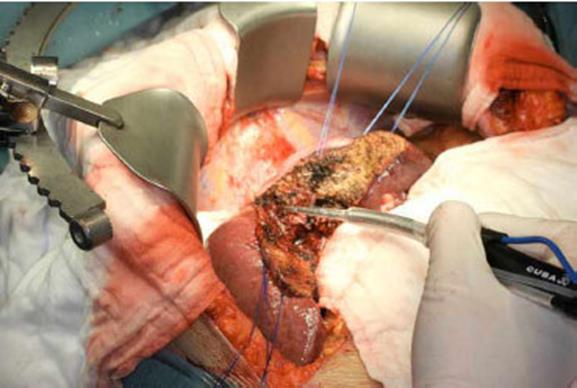 Figure 1: Parenchymal transection using CUSA. Water jet/Hydro jet: It utilises pressurized jet of water instead of ultrasonic energy to fragment the liver parenchyma tissue and expose the vascular and ductal structures and only few randomised studies are in literature to compare this with the standard CCR or CUSA. One study by Rau et al, compared outcomes following liver resection using CUSA and Hydrojet concluded that Hydrojet transection reduced blood loss, blood transfusion, and transection time compared with CUSA. However, this technique has never gained popularity over CUSA and to date both CUSA and water jet techniques are quite good for dissecting out major hepatic veins where tumors are in close proximity and prevents positive resection margin [9]. Ligasure: Ligasure is another device effective in sealing vessels of 7 mm diameter by employing combination of pressurised compression and radio frequency (RF) energy. In a prospective randomised study by Romano et al, authors have reported no clinical evidence of bile leak when Ligasure was employed for liver parenchyma transection of 30 patients though it was failed to achieve good hemostasis in patients with cirrhotic liver [22]. In another published randomized controlled trial the effectiveness of combination of CCR and Ligasure was demonstrated where it resulted in lower blood loss and faster transection speed in minor liver resections compared with the conventional technique of electric cautery or ligature for controlling vessels in the transection plane however, the bile leakage rate with the use of Ligasure alone was 9% compared with 3% in the conventional technique group, but the difference was not statistically significant [23]. Constant et al in 2005 proposed laparoscopic Ligasure to be a useful instrument for laparoscopic liver transection of peripheral liver lesions where it was shown to have similar efficacy as Harmonic Scalpel [24]. Harmonic Scalpel: Ultrasonic/ Harmonic scalpel is a device which was developed to seal small vessels during liver resection. It uses ultrasonic waves to vibrate longitudinal blades at 55.5 kHz and it can be used alone or in combination with CCR or CUSA for better results in order to reduce blood loss and speed up the transection process and to shorten second phase of liver transection where liver parenchyma is transected. Ultrasonic waves coagulates protein by deturing them and generates the heat in vibrating tissue and there by coagulating blood vessels up to 2-3 mm in diameter. Schmidbauer et al, in 2002 studied 41 patients and published the efficacy of Harmonic Scalpel in both open and laparoscopic liver resections, with nobiliary leakage [25]. Aldrighetti L et al in 2006 proposed that when combined with ultrasonic dissection it may reduce the blood loss and it may also be useful in transection of cirrhotic liver, for which the clamp crushing technique may not be the very effective one [26]. **Tissue-Link Dissecting Sealer**: In this instrument, saline flows down to the tip of the electrode and couples with the RF energy on to the liver surface and achieve dissection and coagulation simultaneously with the pointed tip. Poon et al in their preliminary experience of Tissue-Link dissecting sealer without the use of CUSA or CCR for liver parenchyma resection in 10 cases reported the median blood loss of 100 ml (range 30-700 ml) with no postoperative bile leakage. This can also be successfully employed in laparoscopic liver resection [27].
