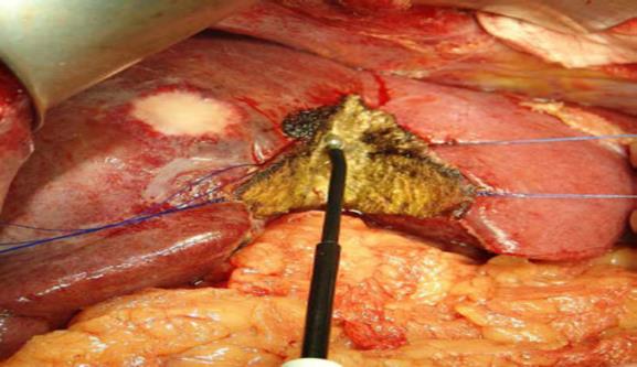 Figure 2: Tissue Link dissector sealer dissecting liver parenchyma Radio-frequency assisted liver transection: This is relatively newer modality of liver parenchymal transection and first applied in detail by Weber et al when he studied its role in 15 patients where he reported mainly segmental or wedge resection and the mean blood loss was only 30+/- 10 ml, and no complications such as bile leakage was observed [28]. Stella et al in 2003 also reported the same results with this technique [29]. One potential disadvantage of these techniques that approximately 1 cm of the normal remnant liver parenchymal tissue is jeopardised at the transection margin which may not be acceptable in patients with liver cirrhosis. Possible thermal injury to the Hilary structures and hepatic veins is another major concern with this device [30]. However, this device is a safe and good option for laparoscopic wedge resection or segmentectomy. This device has been shown to reduce bleeding compared with CUSA in a pilot study [31].