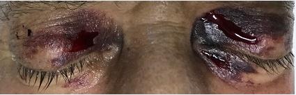 Figure 1: Oozing hemorrhages and ecchymosis are observed just after having removed the adhesive tape. After one week of treatment he was still in the ICU and the examination was done at the bedside. Development of crusts was observed on the eyelids at the areas of abrasion with a regular treatment; however, abrasion on the right upper eyelid started bleeding during the dressing procedure. One day after the last examination the patient died due to a cardiac arrest.