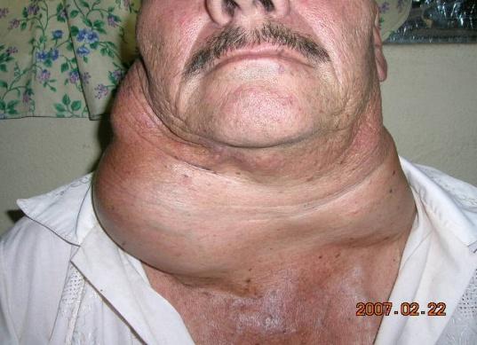 Figure 3: Locally advance thyroid cancer and histophatologic subtype. With AMES prognostic factor 90% were patients with more than 45 years old, 40% with metastasis, 3 with lung metastasis and one patient with spinal metastasis. 100% patients with extra glandular extension and gross tumor major 4 cm [6,7] (Figure 4).