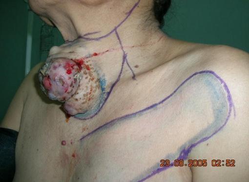 Figure 7: 80 years old woman anaplastic cancer. In Figure 8, 3 patients tracheotomy palliative 30%.