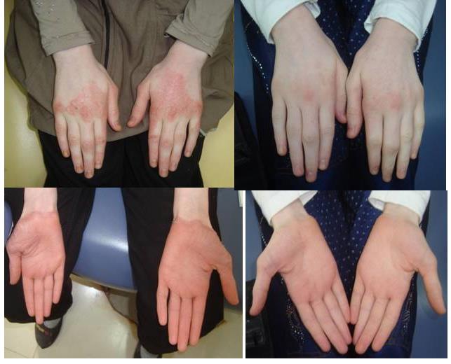Figure 1: Represents pre and post-operative photos of skin lesions.