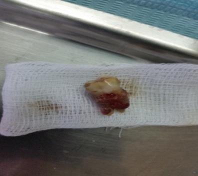 Figure 2: Atraumatic extraction of the tooth.