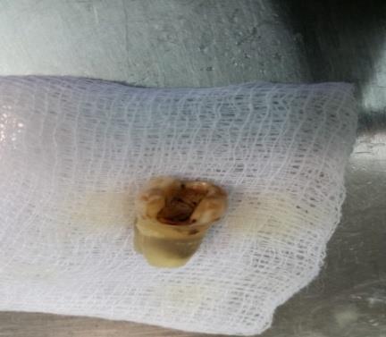 Figure 3: Access cavity preparation and root canal treatment.