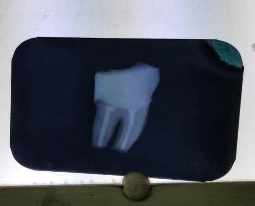 Figure 5: Postoperative radiograph.