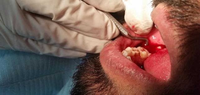 Figure 6: Debridement and curettage of the socket.
