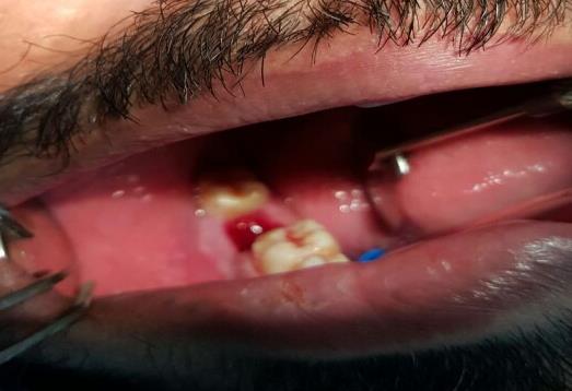 Figure 7: Removal of all the granulation tissue.