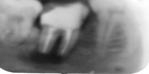 Figure 8: Radiograph after replantation.