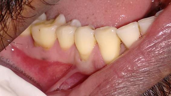 Figure 1: Pre-operative view showing buccal frenum. On examination of intraoral periapical radiograph (IOPA) revealed interdental bone loss between mandibular right molars. The patient underwent full mouth scaling and root planning and was prescribed 0.2% chlorhexidine mouthwash to be used twice daily 20 minutes after brushing with a soft bristled toothbrush and use of desentizing toothpaste over mandibular right first premolar. After 3 weeks, the pocket depth of 5mm was persisting and open flap debridement of mandibular right molars was planned along with frenotomy of the buccal frenum in relation to mandibular right first premolar to prevent further gingival recession of the same tooth. The two procedures were planned together to avoid multiple appointments. The area of interest was anaesthetized using 2% lignocaine with 1: 80000 adrenaline. Open flap debridement with respect to mandibular right molars was done and the flap was sutured using 3-0 silk sutures. Next, as the tissues were already anesthetized, the buccal frenotomy was performed in the following manner. The buccal frenum was made taut by gently averting and pulling out the lips and a small incision was made surgically with number 15 Bard Parker bladeto sever the attached fibres, close to its attachment (Figure 2).