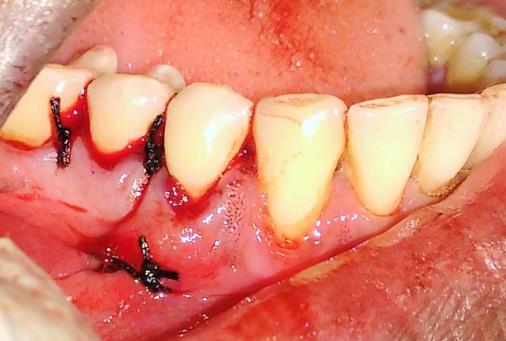 Figure 3: Intraoperative view after suturing. Periodontal dressing was given for mandibular molars and patient was prescribed ibuprofen 400 mg to be taken twice daily for 2-3 days to relieve pain. The sutures and dressing was removed after 1 week. Postoperatively the healing of the tissues at the site of frenotomy was uneventful and the gingival recession depth of mandibular right first molar reduced from 3-4 mm to 2-3 mm (Figure 4). The pocket depth also reduced to 4mm in relation to mandibular right molars and the patient was able to maintain adequate plaque control.