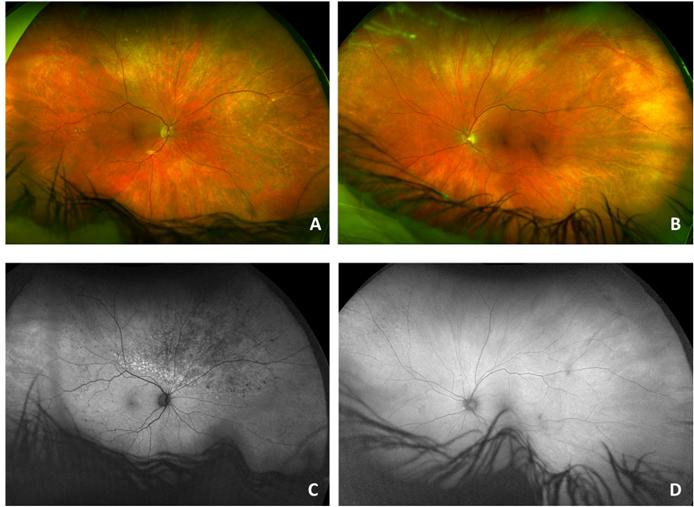 Figure 3: Autofluorescenceimage of left eye showing multiple hyper-autofluorescent punctate lesions noted temporally. The patient was referred to an oncologist and underwent a systemic workup. Her brain MRI showed no evidence of CNS disease. She underwent a lumbar puncture which showed no signs of malignant cells. A full body positron emission tomography (PET) scan showed no systemic involvement. The course of treatment recommended by oncology depended on demonstration of bilateral versus unilateral disease. If the disease is definitively in both eyes, systemic methotrexate treatment is recommended, following the CNS lymphoma protocol. If the disease is only unilateral, local treatment with intravitreal methotrexate is recommended. To evaluate for evidence of bilateral disease, a small sample of vitreous was aspirated from the left eye. Flow cytometry on this specimen revealed no abnormal T cell populations. This was not unexpected given the small sample size of vitreous aspirate compared to vitrectomy with biopsy. A study showed that only 7.4% of patients were diagnosed with vitreous tap, with 63% of patients demonstrating at least one false negative and most patients requiring 2 procedures for diagnosis [3]. The patient declined vitrectomy as she was asymptomatic in that eye. Full field electroretinogram (ERG) revealed that the rod and cones had normal amplitudes but the implicit times were delayed in both eyes for both rods and cones. The rod implicit time in the right eye was 57.5ms and 58ms in the left eye, with the normal range being 43-52ms. The cone implicit time in the right eye was 37.5ms and 36.5ms in the left eye, with the normal range being 25-31ms. Multifocal ERG showed that the amplitudes of the perifoveal wavelets were reduced in both eyes, with the right eye being more significantly affected than the left. Due to the above findings and the overall clinical picture, it was decided that the patient likely had bilateral disease. Treatment options were discussed with the patient, and she declined systemic treatment, instead opting for a course of bilateral methotrexate intravitreal injections. Improvement of the lesions was observed clinically and on auto fluorescence in both eyes after several months (Figure 4). She was given 25 injections OD and 13 injections OS (withheld due to macular cysts and MTX toxicity) over the course of one year. Two months after her final injection, she presented to the hospital with weakness and lethargy. MRI detected new basal ganglia mass and midline shift. She was intubated and decision was made for comfort care measures.