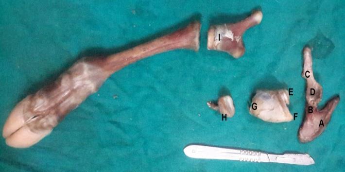 Figure 5: Growth anatomy of the accessory limb: Undeveloped pelvic bone (a wing of the ilium (A), a body of the ilium (B), a body of the ischium (C), with an acetabulum (D). Short femur with a small undeveloped head (E) and trochanter (F) proximally, and enlarged end distally (G). Rudimentary proximal end of the tibia (H). Enlarged calcaneal bone (I). Normal metatarsus and phalanges with tightly fixed joints.