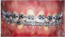Figure 3: Intra oral images showing tooth size discrepancies. The mock up: The esthetic outcome is clinically previsualized through a direct mock up. The purpose is also to “deprogram” the patient from the previous situation. It remained in situ until the next appointment to ascertain esthetic, phonetics and function. In fact, the length and shape of the future restorations, the absence of interferences, the correct pronunciation as well as the patient comfort were assessed. Few corrections were required during this step to live up to the patient’s esthetic expectations. Prosthetic decision: Owing to its conservative aspect and excellent esthetic result, the decision to perform lithium disilicate veneers from tooth #13 to tooth #23