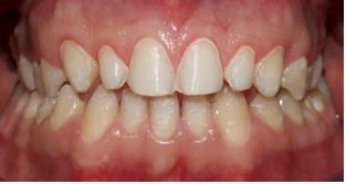 Figure 5: Digital model with virtual veneers. Try in protocol: Removal of the provisional restorations was straightforward. Tooth surfaces were thoroughly cleaned. Each veneer was tried on the prepared tooth. All these parameters were checked: precise marginal fit, correct length and mesio-distal dimension, adequate contour in harmony with the surrounding tissues, color mimicry to natural adjacent teeth and proper esthetics improving the patient’s smile. The adhesive cementation was programmed in the following appointment. A step by step bonding procedure: The rubber dam, key to success to bonding procedure, was carefully positioned between the first two premolars to achieve adequate isolation (Figure 6).