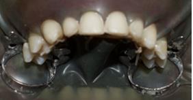 Figure 6: Rubber dam application. Extreme care was taken during the bonding protocol. The following sequenced steps were meticulously Considered • Conditioning of the ceramic veneers: The internal surfaces were etched using 9% hydro fluoride acid (HF) for 60 s, then rinsed and thoroughly cleansed. Placing the veneers into a container of 95% alcohol and putting it into an ultrasonic bath for four minutes was crucial for the removal of any impurities that may interfere with the adhesion mechanism. Thus, the internal veneer surfaces looked clear and had similar appearance of etched enamel. Then, the silane coupling agent was applied followed by the five-second evaporation of its solvents and activated by hot air. Just before placing the veneers, a bonding agent was applied without photo polymerization (Figure 7).