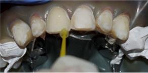 Figure 9: Frosty white appearance confirming well etched enamel.