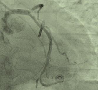 Figure 1: Trifurcation of LM with totally occluded ramus branch. We decided to do PCI to the culprit lesion which was the ramus branch. A 6 Fr EBU guiding catheter was engaged into the left main via the right radial artery and 0.014-inch coronary wire was placed into the ramus artery. Aspiration catheter was used but it didn’t cross the ostium of the ramus branch because of the encroachment of the stent of the LAD. The ostium of ramus showed severe ostial stenosis. As a results of trials of aspiration, the ramus branch appeared as a big and sizable artery. Predilatation was done with balloons 1.5x15 and 2.5x15 the LAD and LCX was compromised, so we inserted 2 wires into the LAD and LCX through femoral artery with another guiding catheter into the left main (Figure 2). We did inflation of LAD, LCX and ramus branch at the same time (Figure 3).
