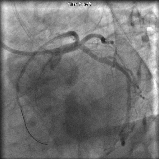 Figure 4: Successful PCI of the complex trifurcation lesions.