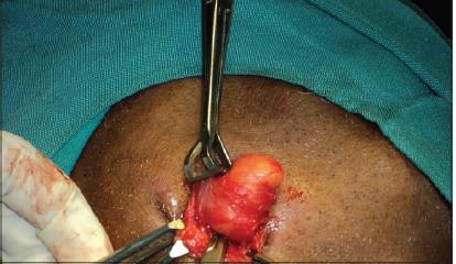 Figure 2: Gross specimen being well encapsulated and separated from surrounding structures (left side of the neck). Histopathological examination of the specimen showed polygonal shaped cells, with clear cytoplasm and eccentrically placed nucleus.. These features were suggestive of lipoma (Figure 3).