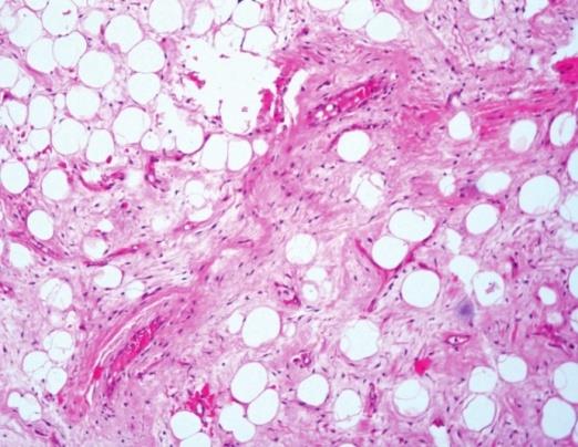 Figure 3: Photomicrograph showing polygonal shaped cells, with clear cytoplasm and eccentrically placed nucleus.