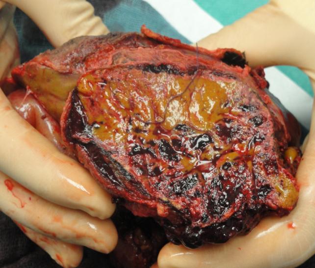 Figure 1: Cut surface of the explanted liver