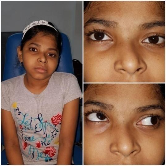 Figure 2: Preoperative photograph showing inferior oblique over action following congenital SO palsy and Postoperative photograph after IO recession.