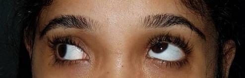 Figure 3: Face turn to right side, left eye hypertropia, left eye inferior oblique overaction and left eye superior oblique under action following traumatic SO palsy.