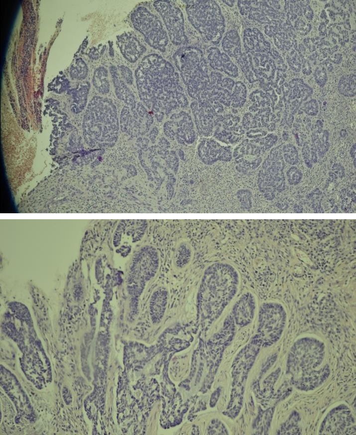 Figure 3: (A), (B) and (C): nodular basal cell carcinoma with adenoid differentiation, well defined nodules with peripheral nuclear palisading and retraction spaces, and glandular-like lumina (x 10).