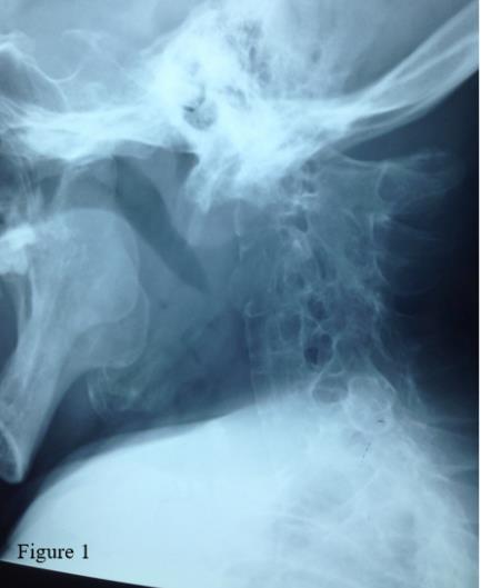 Figure 1: Radiograph of a cervical spine showing a vertical atlantoaxial subluxation complicating spondyloarthritis.