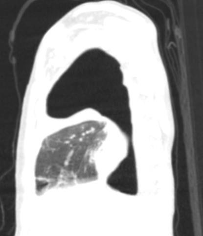 Figure 6: X-ray of chest after bronchial lavage and temporary bronchial occlusion.