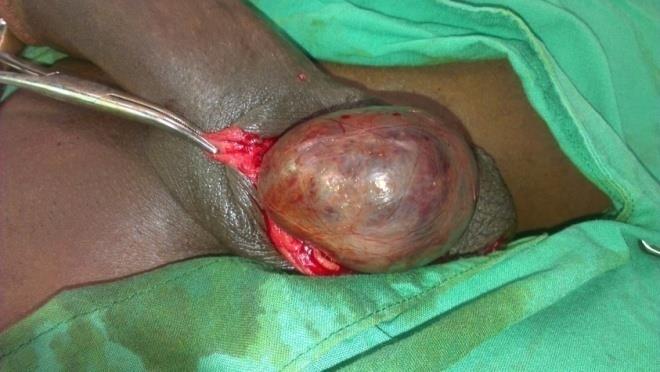 Figure 1: Necrotic testis after six days of evolution.