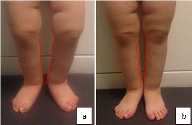 Figure 2: Varus knees improvement: before (a) and after (b) 1 year of treatment with calcitriol and Joulie's solution. The DNA study detected missense mutations R179Q in FGF23 gene. This result confirmed the diagnosis of ADHR, sporadic presentation in our index case. Family history and gene screening of both parents were negative.