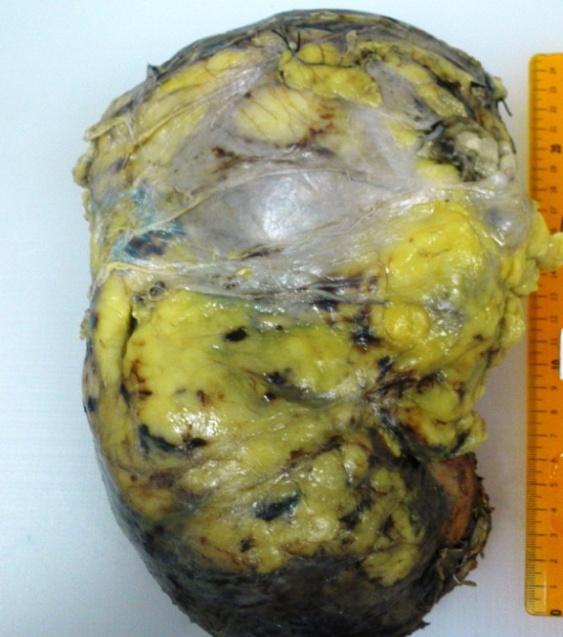 Figure 1: Macroscopic Image: Nephrectomy shows tumorlesion with a varied surface showing whitish, fleshy and friable, bleeding, with necrotic areas, compromising the entire specimen.