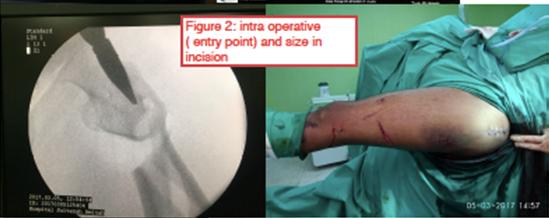 Figure 2: Intra operation (entry point) and size in incision.