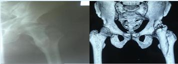 Figure 1: (A) Anteroposterior hip x-ray at initial admission; complete anklyosis of the hip from pelvis to trochanteric region is seen. (B) CT of the hip revealed normal joint space with a bridging heterotopic ossification over the anterior joint capsule.