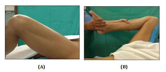 Figure 2: A) Left Hip Flextion, B) Right Hip Flextion.