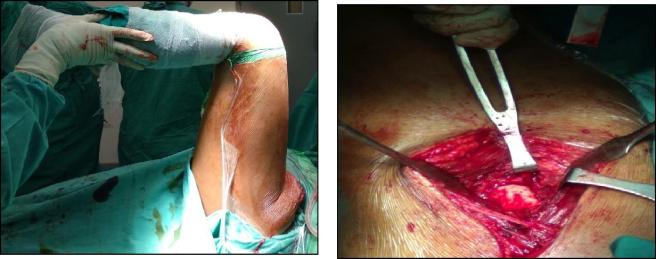 Figure 3: Intra Operavite Left Hip Flexion, B: Bony Bar of Left Hip.