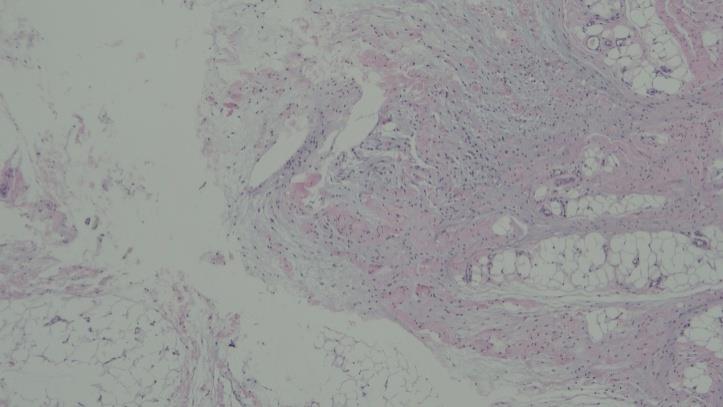 Figure 2: One section showed the myxoid change in the transplanted fat cells after 3cc bolus injection of autologous fat. (H&E x 40). Zones C and D were designed to compare mono injection of PLLA and co-injection of PLLA with autologous fat. The histological results revealed that granulomatous reactions were found in a number of consecutive sections in zones C and D. Histologically, mixed transplanted fat and granulomatous reactions in the muscular layer were observed, but interestingly, these granulomas had no special interactions with fat nearby, without fat necrosis or special inflammation (Figure 3).